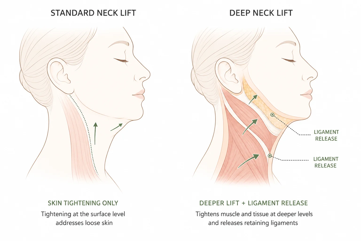Deep Neck Lift vs Standard Neck Lift Comparison